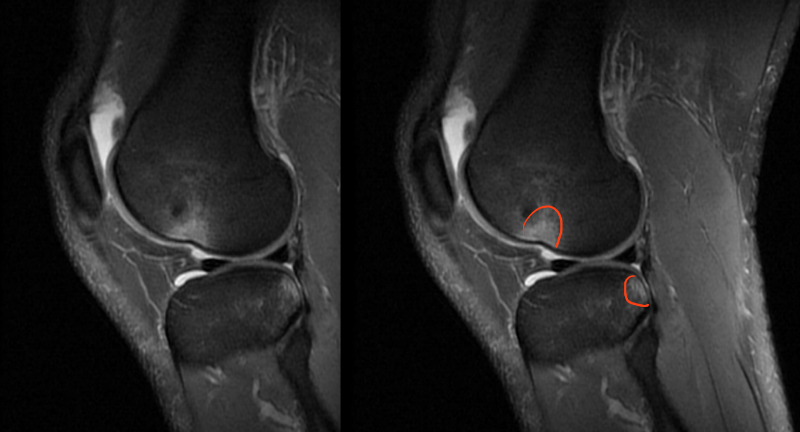 Chirurgie ligamentaire Lyon - Rupture ligament croisé antérieur