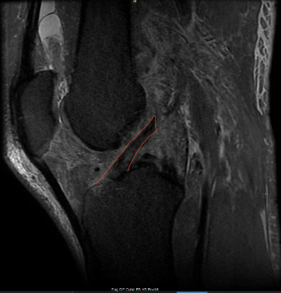 Réparation du Ligament Croisé Antérieur: Rêve ou Réalité?